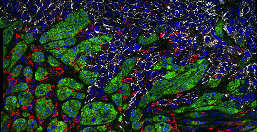 microscopic image of breast cancer cells interacting with immune cells