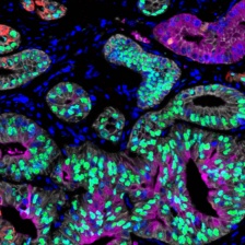 tumor cells from pancreatic cancer patients 