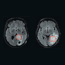 scans of two brains with tumors