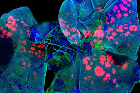 cancerous lung tissue targeted with nanoparticles