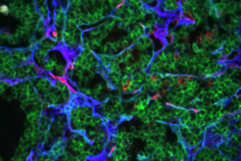 Deposits of fibronectin (blue) around the vasculature in the extracellular matrix of a pancreatic tumor