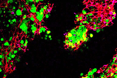 lung metastases