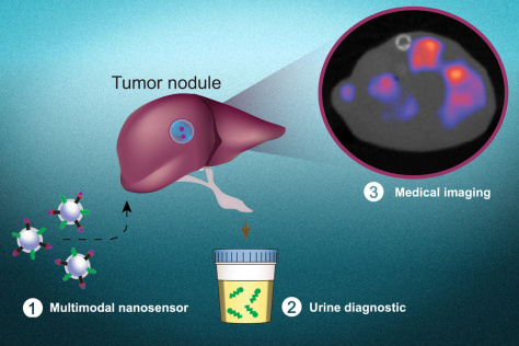 schematic view of multimodal nanosensors with a urine cup and a tumor module, highlighted to show a heat map of cancer locations