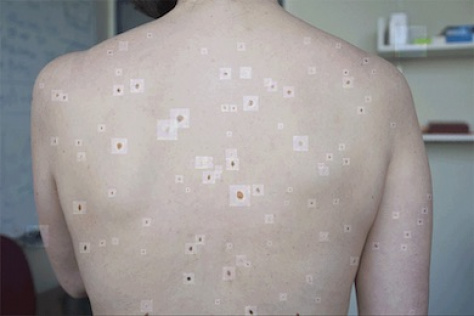 image of a white person's back with moles highlighted by rectangular overlays