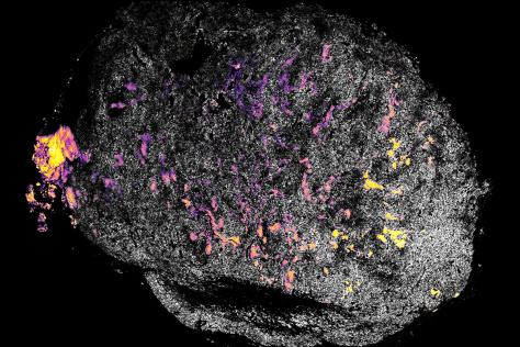 a tumor imaged after treatment, stained pink for IL12 and yellow for alum