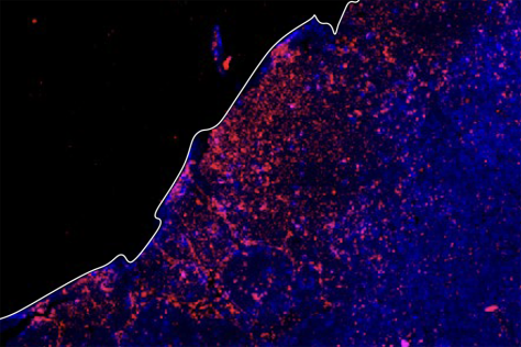 a tumor draining lympnode stained in red and blue; a sharp white edge divides it diagonally from the blackground