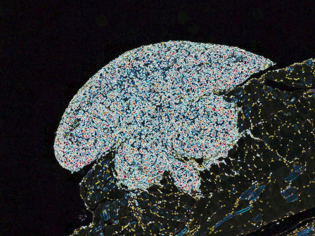 White ovarian tumor invading into dark abdominal wall tissue