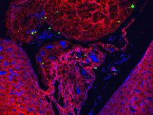 Green nanoparticles dot spongy red and blue tumor tissue 